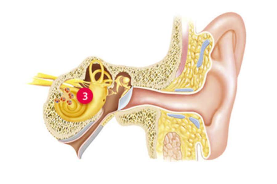 Sensorineural hearing loss