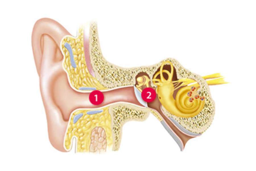 Conductive hearing loss